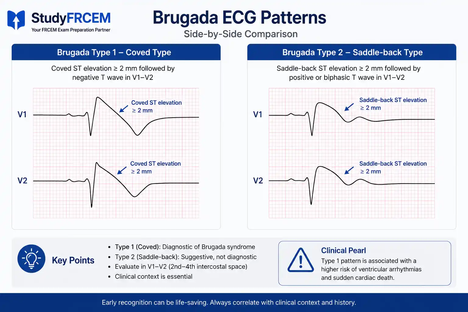Side-by-side comparison of Brugada Type 1 (Coved) vs. Type 2 (Saddle-back) in leads V1-V2.