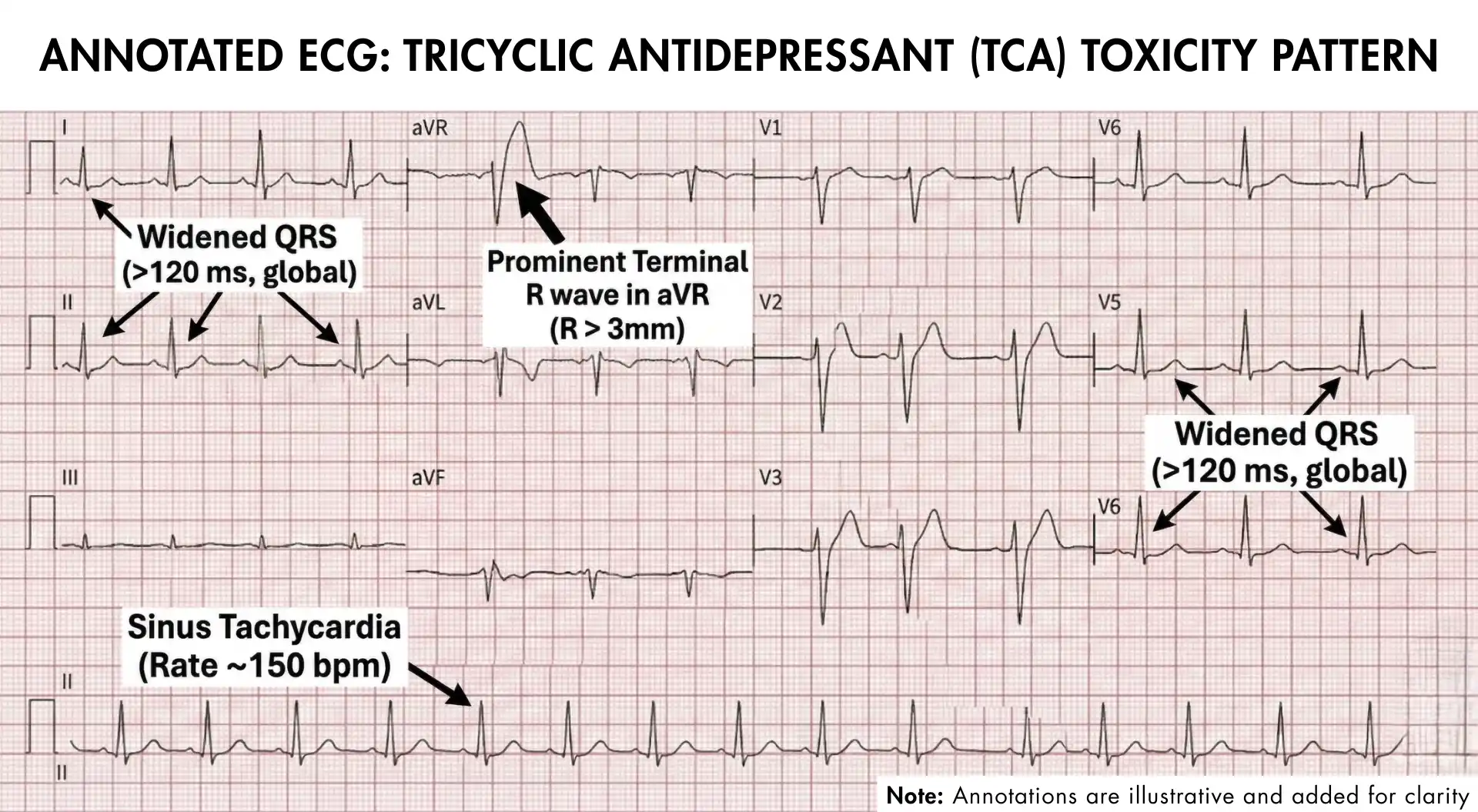 Annotated ECG showing sinus tachycardia, widened QRS, and prominent terminal R wave in aVR typical of TCA toxicity