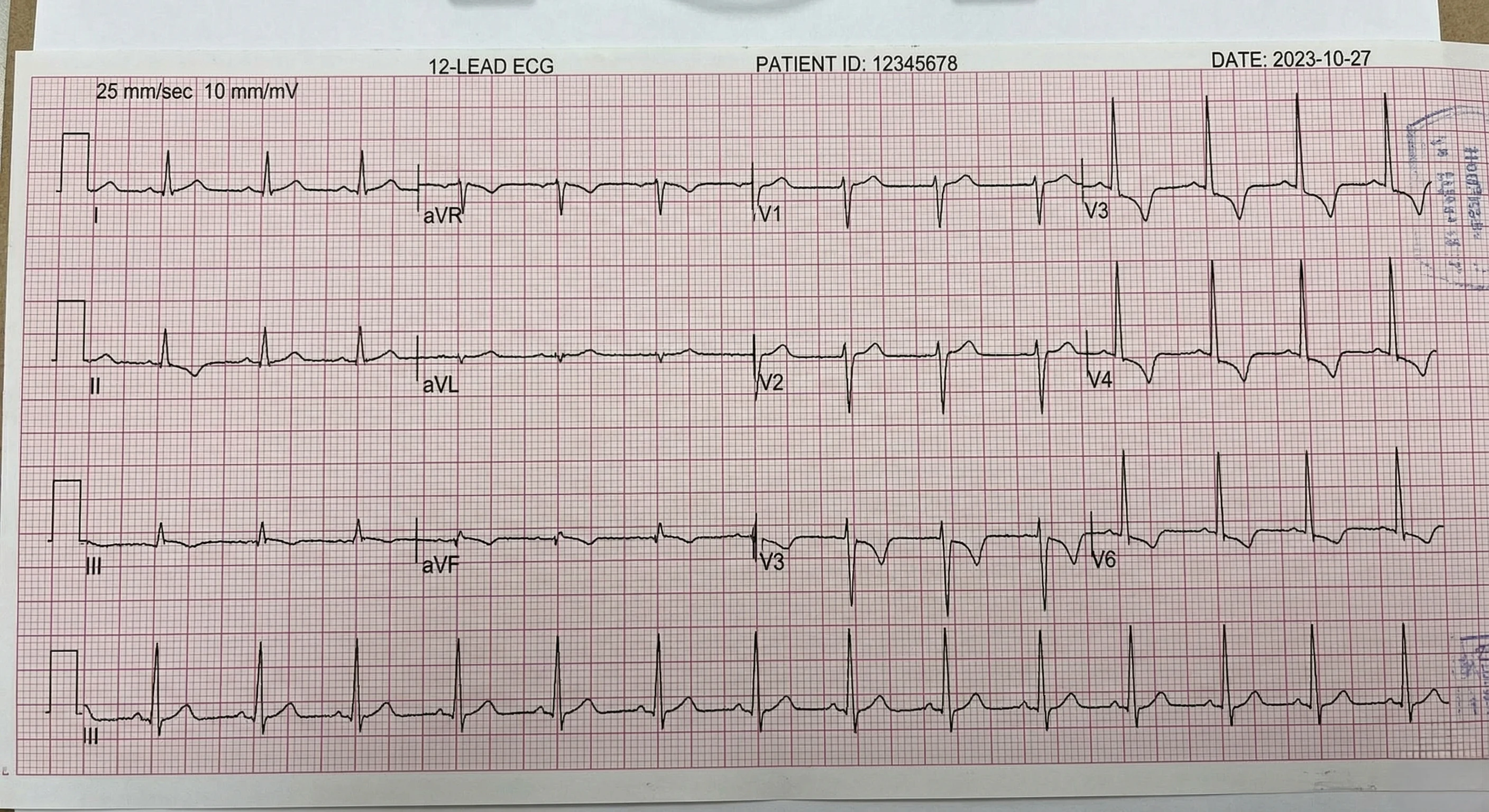 ECG trace showing NSTEMI with horizontal ST depression in multiple leads