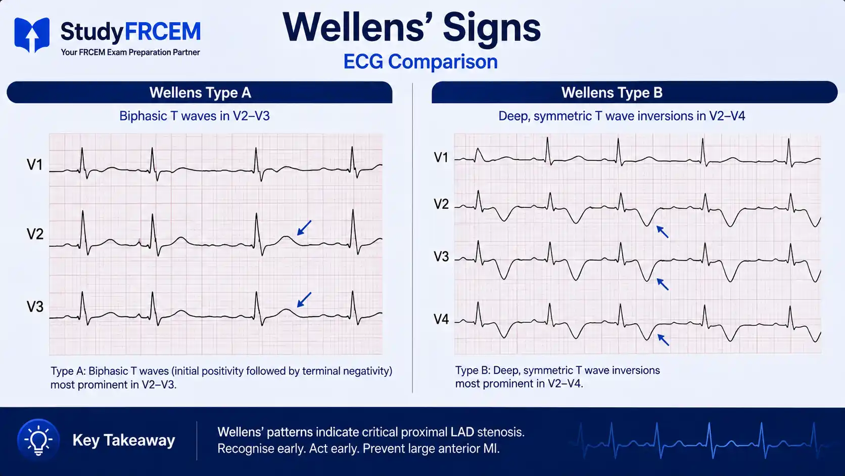 Side-by-side ECG comparison of Wellens Type A (biphasic T waves V2-V3) and Type B (deep symmetric inversions V2-V4)