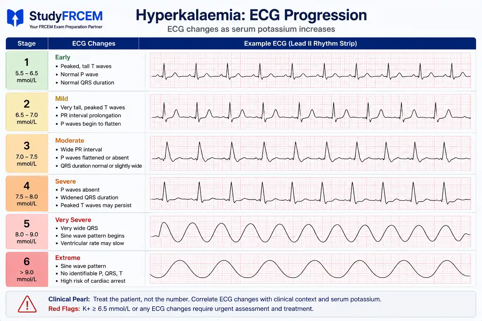 Sequential ECG strips showing hyperkalaemia progression from peaked T waves through to sine wave pattern